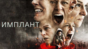 Имплант